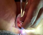 Dilating to 9mm w Tenaculum and Hegar from mm flashing pussy