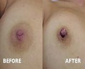 Inverted Nipple Correction - Audio Testimonial Photos - Aurora Clinics from nathiya long nipples photos